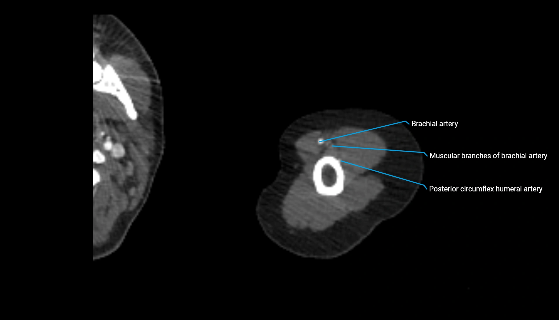 CTA upper limb axial cross sectional anatomy labelled image 286 (2).webp